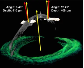Figure  1.15.  OCT  3-D  in  vivo  positioning  of  the  ICRS  inside  the  cornea 