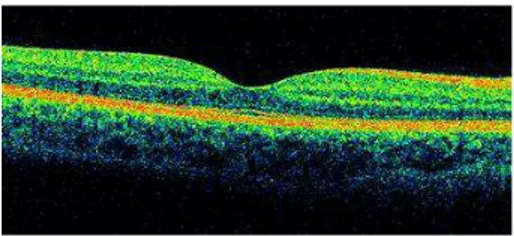 Figura 1. Imagen retiniana obtenida con OCT de dominio espectral a nivel macular. 