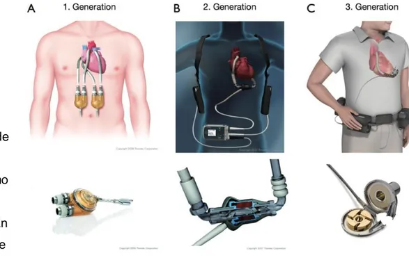 Figura 4. Dispositivos de asistencia ventricular. (A) Thoratec PVAD. (B) 