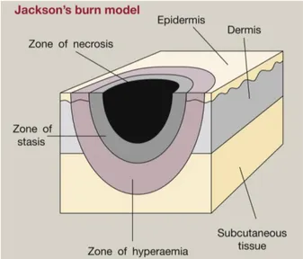 Figura 3. Zonas de una quemadura, según Jackson 17 . 
