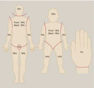 Figura 8. Regla de los 9, o método Wallace, para adultos (izquierda) y niños (centro) y regla de  la palma de la mano (derecha) 28 