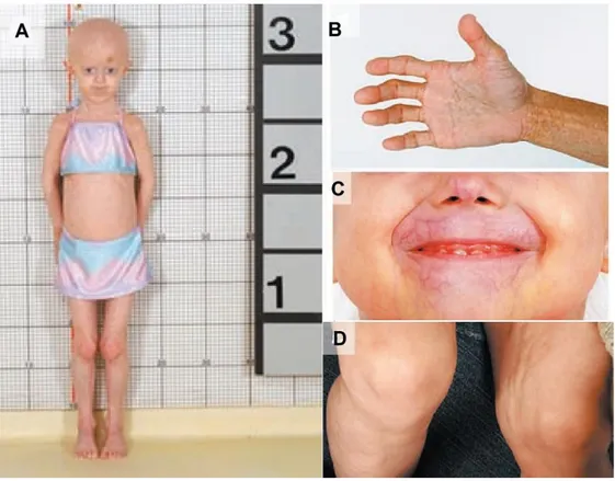 Figura 1. Hallazgos físicos en niños con síndrome de HGPS 
