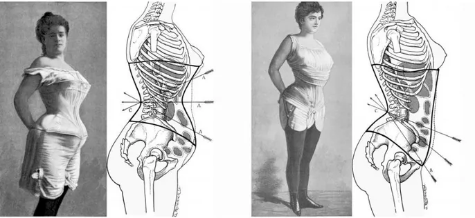 Figura 2. A la izquierda vemos los efectos de un corsé Sablier y a la derecha los  efectos de un corsé abdominal.