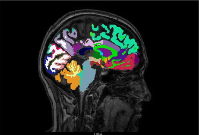 Figura	 1	 -	 mapeado	 cerebral	 con	 las	 distintas	 regiones	 anatómicas,	 superpuesto	 a	 la	 imagen	 de	 la	 resonancia	magnética.	