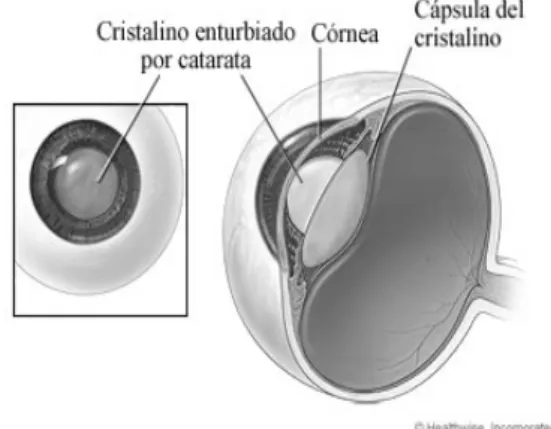 Ilustración 2. Catarata, opacificación del  cristalino. 