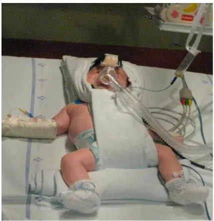 Figura 1: CPAP con interfaz tipo máscara nasal. 