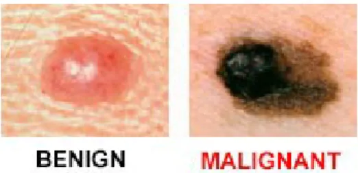 Ilustración 4 Melanoma 