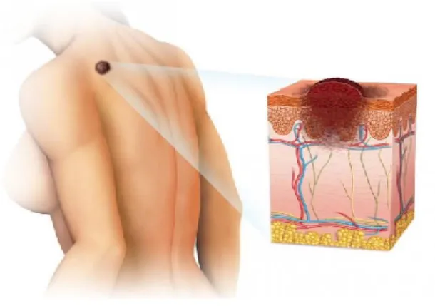 Ilustración 1 Melanomas malignos 
