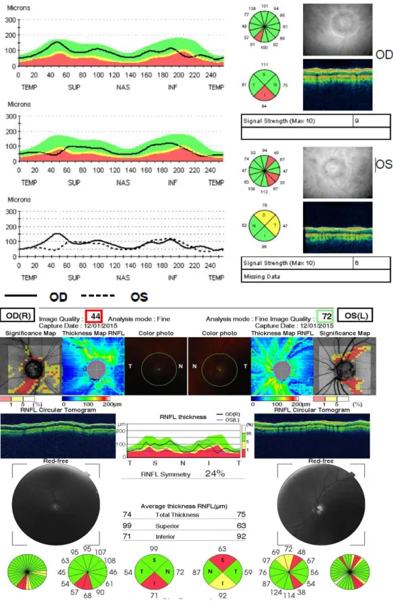 Figura 1.2: En la parte superior hoja de resultados OCT Stratus con en el  programa  “Fast  RNFL  Thickness  (3:4)”  y  el  parte  inferior  hoja  de  resultados de OCT 3D Topcon en el programa “3D Disc”.