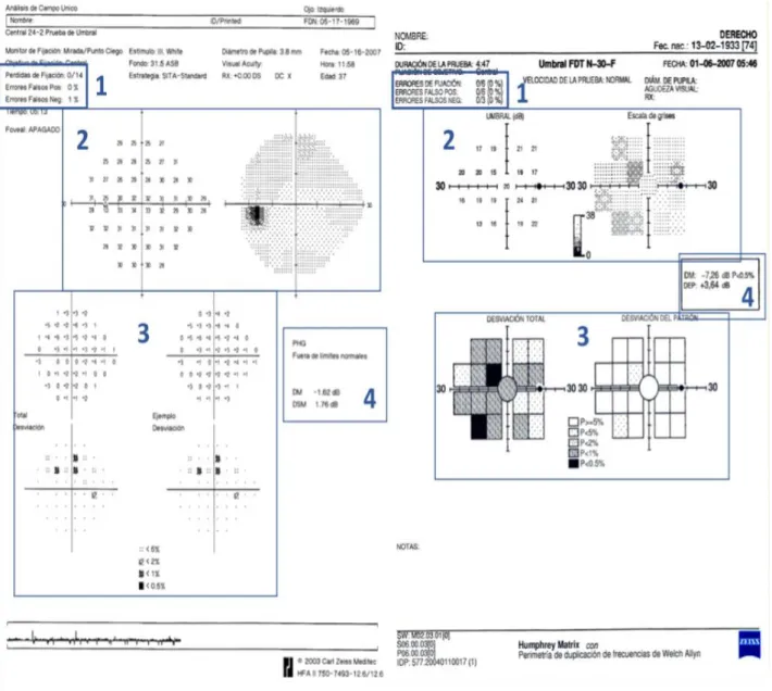 Figura  1.4:  Hoja  de resultados  de la  perimetría  SAP:  izquierda,  perímetro  Humphrey  programa  de  exploración  24-2,  derecha,  perimetría  FDT Matrix  (programa  de  exploración  N-30-F)