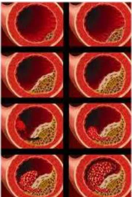 Figura 2.4.1 Desarrollo de una placa de ateroma  FUENTE: http://endocrinologopediatra.mx/tag/ateroma/ 