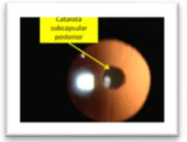 Fig 4: catarata subcapsular posterior 