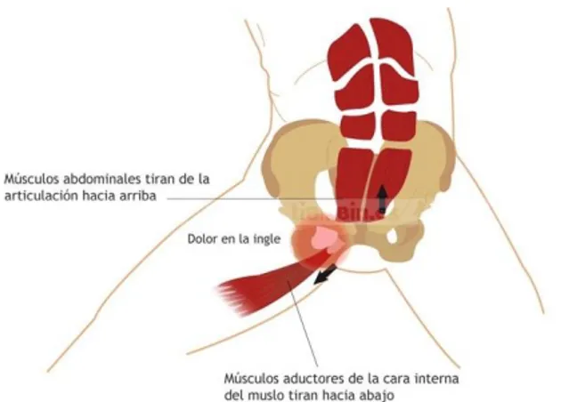 Figura 6. Aductores fuertes frente a abdominales débiles. 