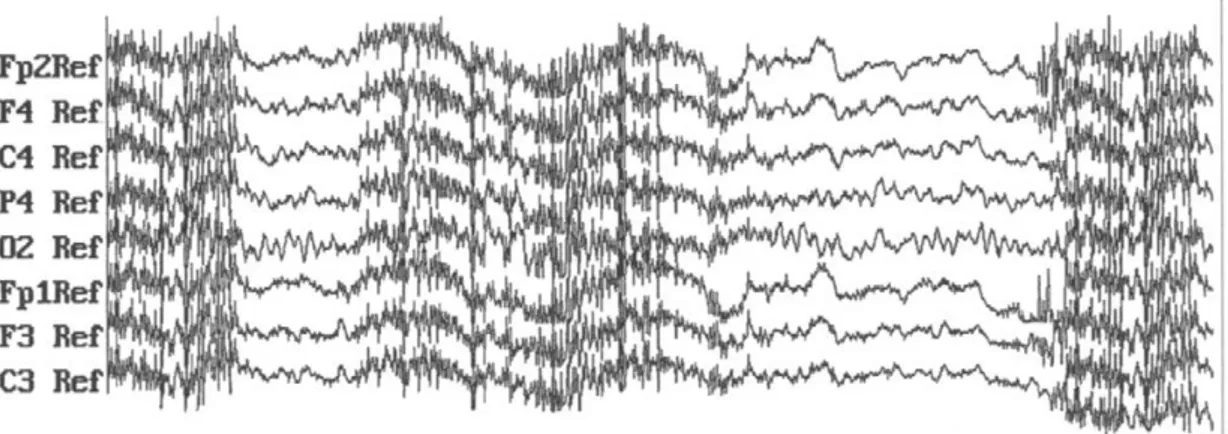 Figura  2-13.  Registro  de  5  segundos  de  duración  de  la  señal  EEG  contaminada  por  episodios 