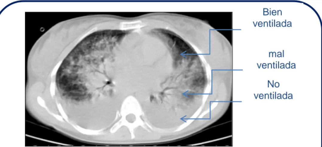 Figura 3. Distribución heterogénea de las lesiones pulmonares en el SDRA  visualizadas en TC  