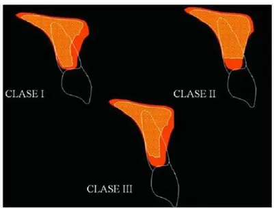 Fig. N° 09: Clasificación de Seibert. 