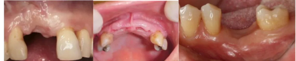 Fig. N° 08: Reborde dentario. Tomado de la Revista de operatoria Dental.  