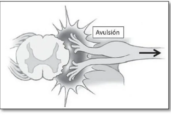 Figura 5. Lesión preganglionar y avulsión de  las raicillas. 