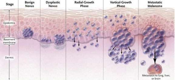 Fig.  1.  Desarrollo  de  melanoma.  En  la  fase  de  crecimiento  radial  se  puede  observar  como  algunas 