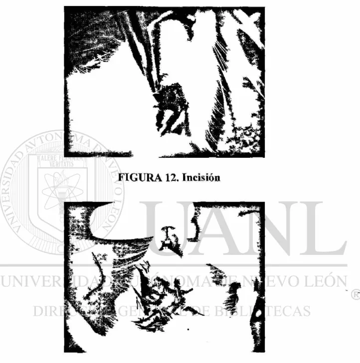 FIGURA 13. Sutura 