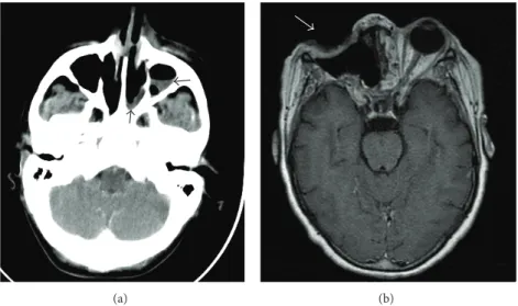 Figure 1: (a) An example of a computed tomography showing sinusitis (black arrows). Biopsies were positive for mucormycosis in this patient