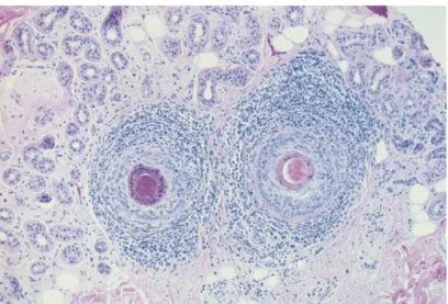 Figura 8.- Infiltrado inflamatorio linfoc“tico en región peribulbar. Tinción  hematoxilina-eosina  