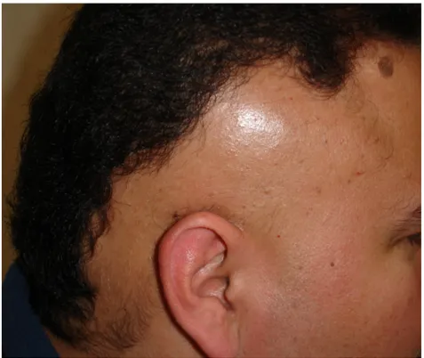 Figura 2.- Alopecia areata patrón ofiáceo 