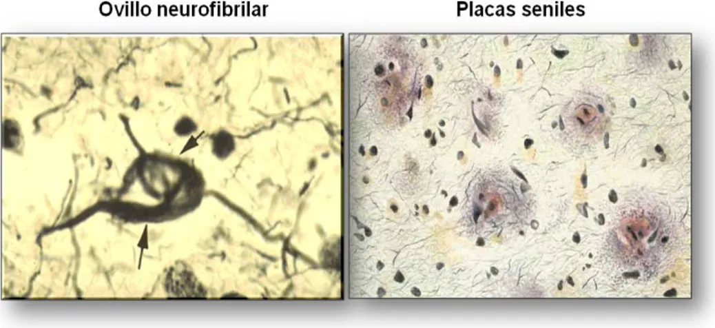 Figura 3. Características neuropatológicas de la Enfermedad de Alzheimer. La 