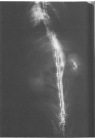 Fig.  1.  Plasma methylene blue concentration-time profile  shows that absorption after epidural perfusion is biphasic:  rapid initial absorption is followed by much slower second  phase