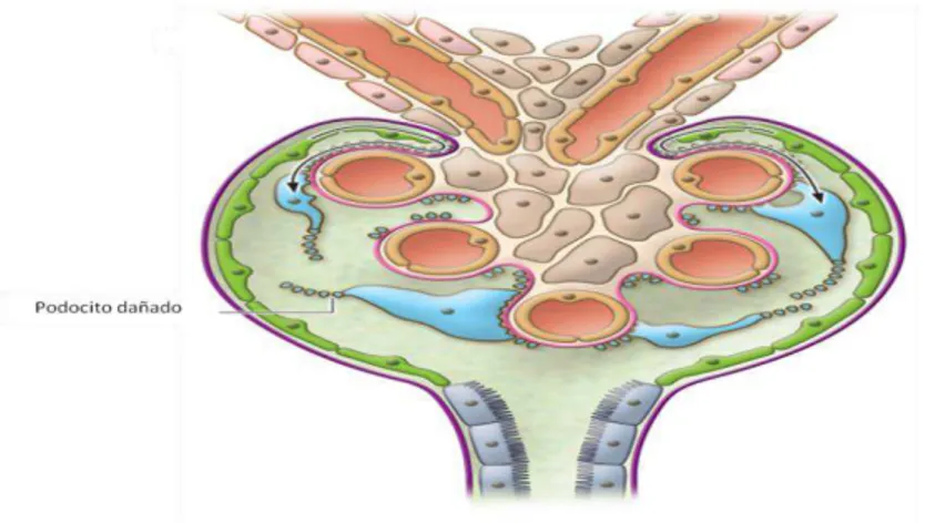 Figura  7.  Estructura  del  glomérulo  con  lesión  en  el  podocito.  Lesión  a  nivel  de  podocito  con  desprendimiento de la membrana basal glomerular
