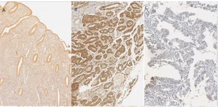 Figura 5: Expresión de la inmunohisquimica de PTEN. A) Control de PTEN en endometrio  proliferativo, B) Positivo, C) Negativo 
