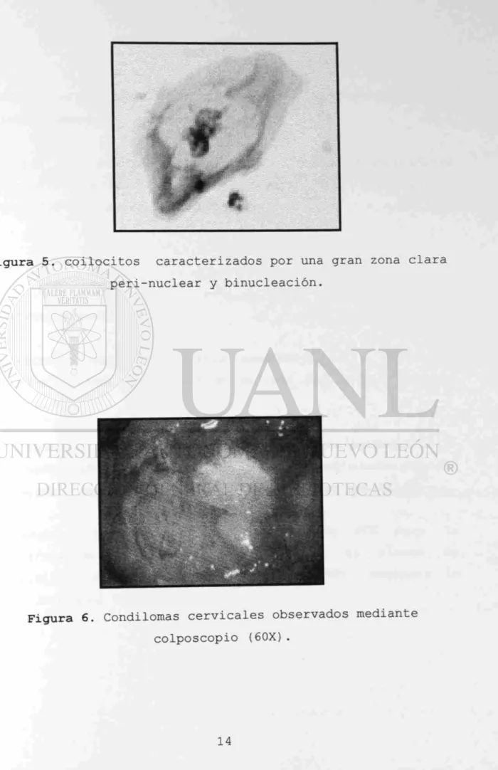 Figura 5. coilocitos caracterizados por una gran zona clara  peri-nuclear y binucleación