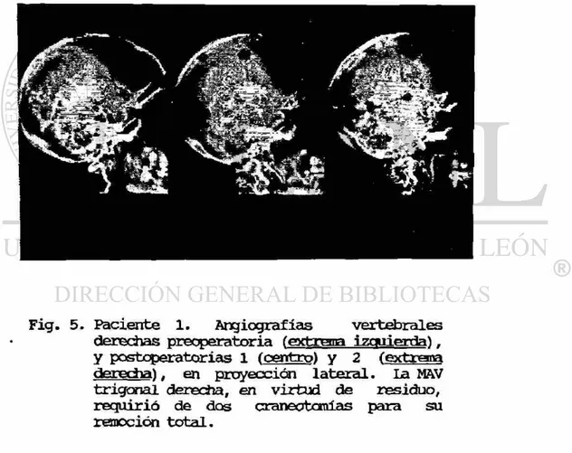 Fig. 5. Paciente 1. Angiografias vertebrales  derechas preoperatoria (extr&#34;&#34;* izquierda),  y postoperatorias 1 (centro) y 2 (extrema  derecha), en proyección lateral