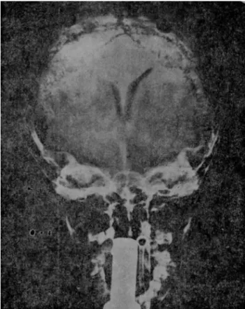 Figure 5 Benign intracranial hypertension. Ventriculography of a 4-and-a-half year old boy with benign intracranial  hyper-tension, which occurred during treatment with steroids