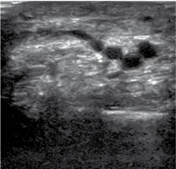 Figure 1  echographic image showing the veins that give ter- ter-minal relux to the venous ulcer.