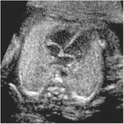 Figura 5. Corte de 4 cámaras cardiacas. 