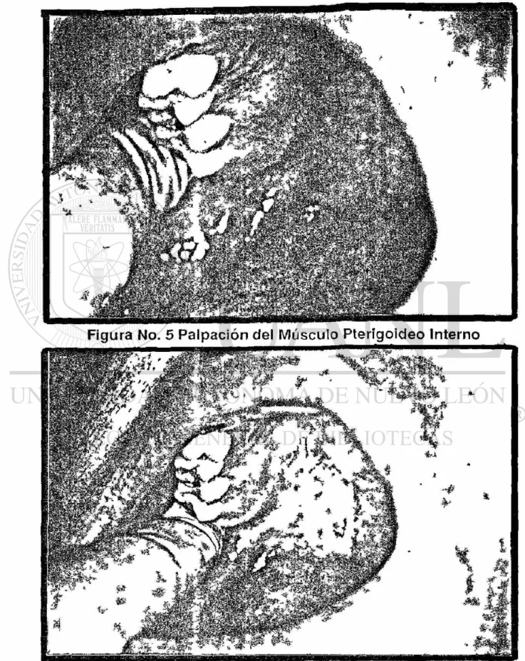 Figura No. 5 Palpación del Músculo Pterígoideo Interno 