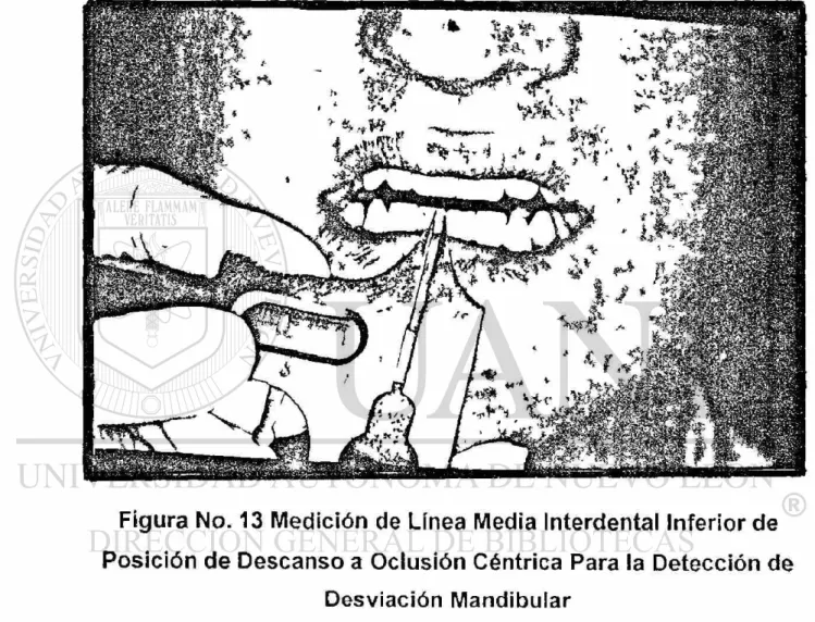 Figura No. 13 Medición de Línea Media interdental Inferior de  Posición de Descanso a Oclusión Céntrica Para la Detección de 