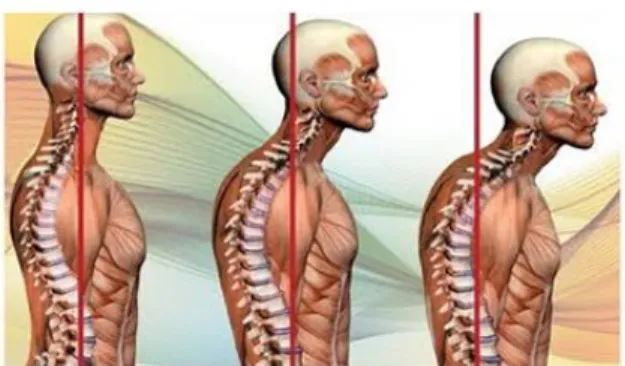 Fig. 5 Postura de paciente con cifosis (keytobeauty.com) 