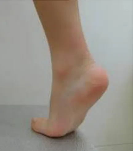 Fig. 8 Paciente apoyando en puntillas (podiatrytoday.com) 