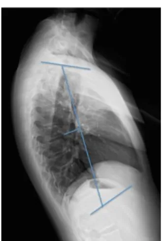 Fig. 9 Trazado con método de Cobb 