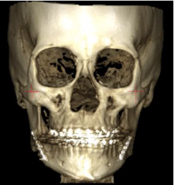 Figura 9. CTCB post operatorio  Set Back Mandibular 