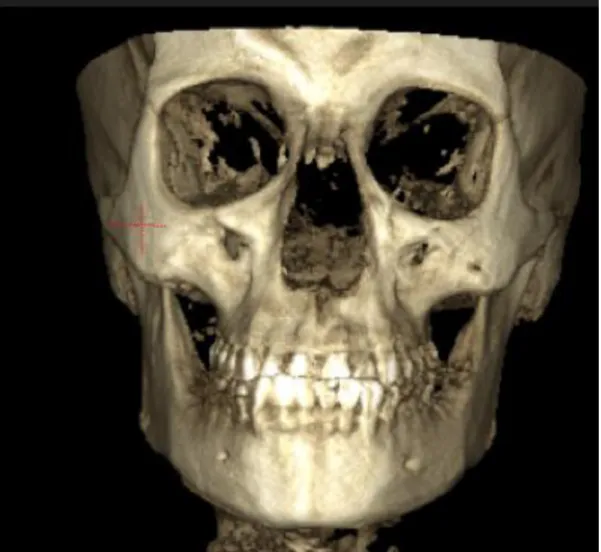 Figura 10. CTCB pre operatorio 