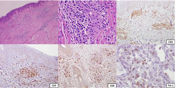Fig. 2.  Immunohistochemical staining of a skin biopsy showing diffusely positive CD3 and CD5 cells and  focally positive CD8 and TIA-1 cells