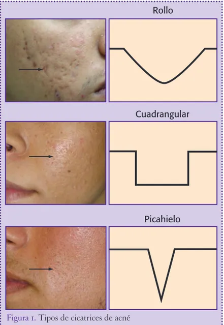 Figura 1.  Tipos de cicatrices de acné