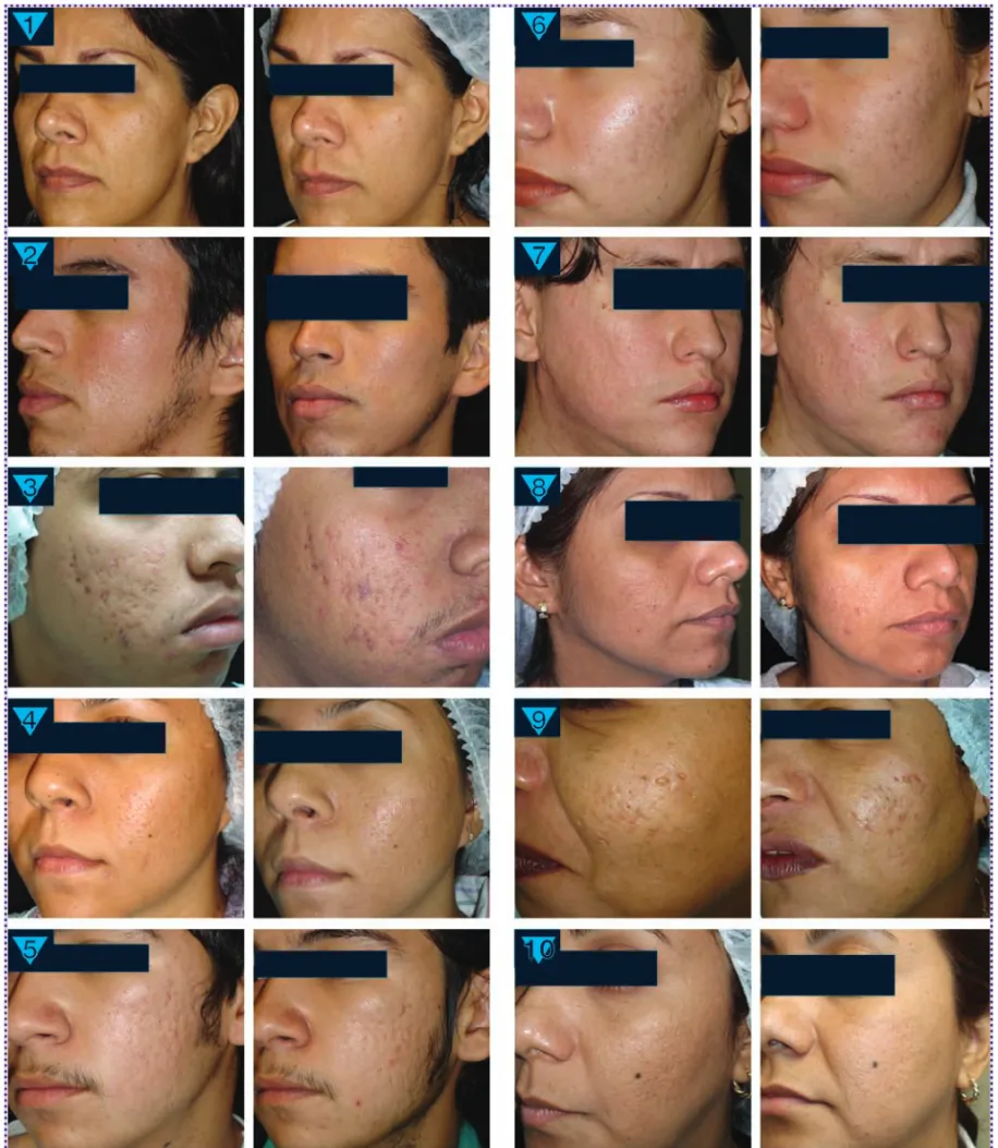 Figura 2.  Fotos de 10 pacientes antes (izquierda) y después (derecha).