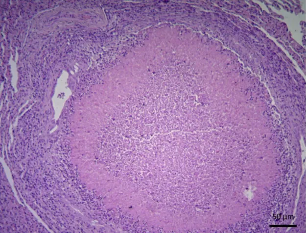 Figura 3.- Bronquiectasia 