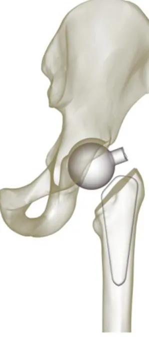 Figura 2.7 Fractura en la zona del cuello de un espaciador temporal de cadera .