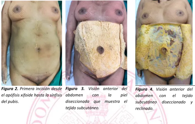 Figura  2.  Primera  incisión  desde 