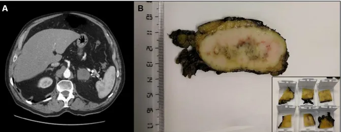 Figura  3.  Metástasis  en  suprarrenal.  A:  Imagen  de  TAC  que  muestra  corte 